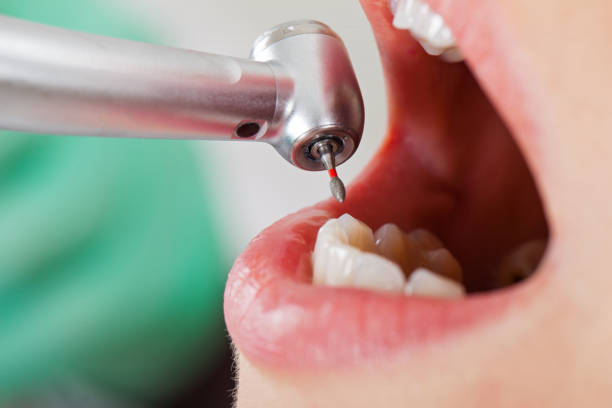 Best Emergency Wisdom Teeth Removal in Green Tree, PA